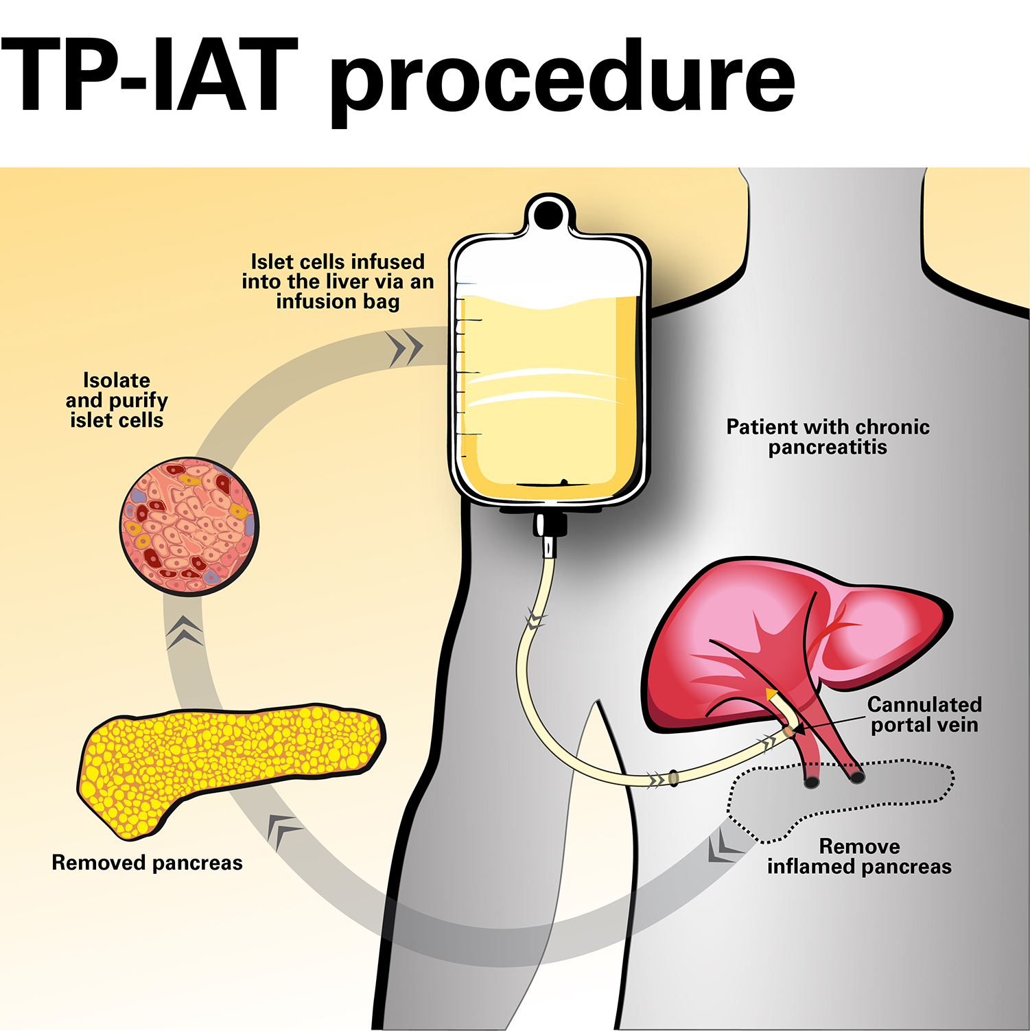 Diagram showing Islet Auto-transplantation